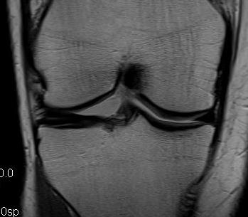 Discoid Meniscus MRI 2